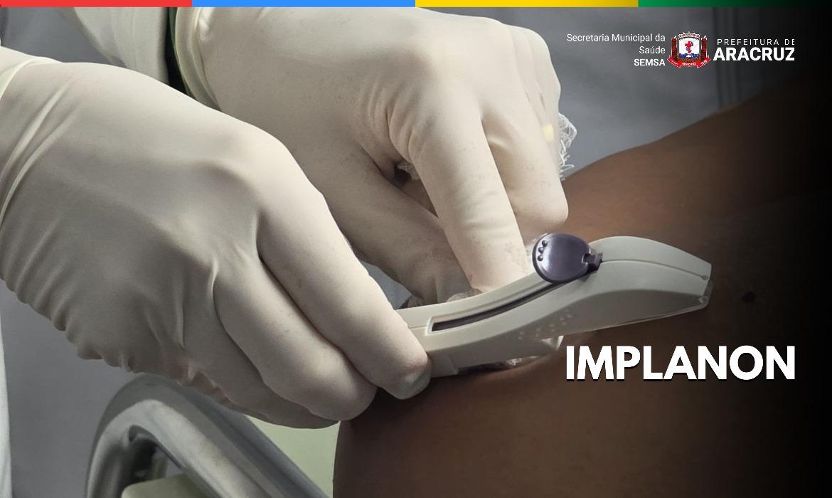 Saúde institui protocolo para oferta do Implanon na Atenção Primária à Saúde
